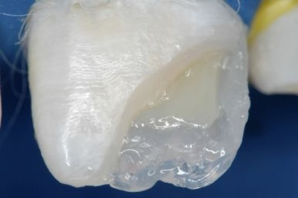 Confecção do corpo dentinário do terço médio com Resina Llis DA3 (FGM).