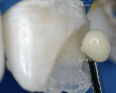 Notar a integração das massas de dentina.