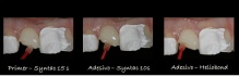 Após o condicionamento com ácido fosfórico do dente 11 (30s esmalte e 15s dentina) fez-se o condicionamento do dente com o sistema adesivo Syntac (primer 15s, Adhesive 10s e Heliodond)