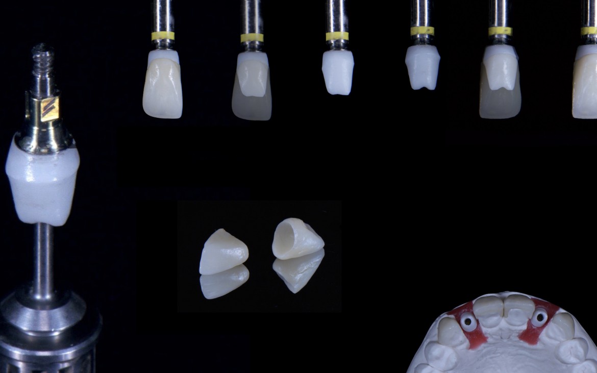 Abutments personalizados de zircônia e coroas de emax para próteses sobre implantes