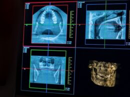 Imagens de radiografias sendo análisadas por dentista legal.