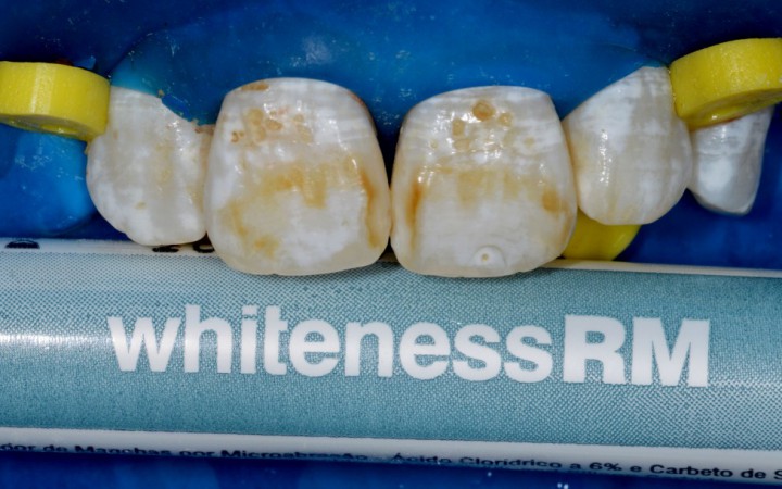 O tratamento foi iniciado isolando somente os dentes incisivos superiores para que a paciente experimentasse os resultados da técnica de microabrasão