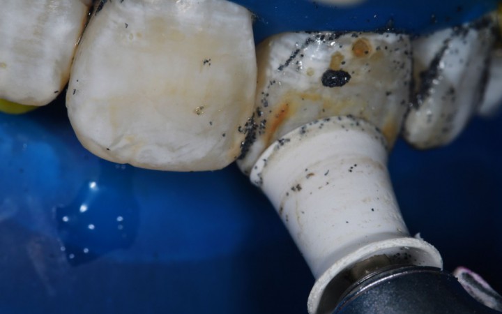 Após a aplicação nos dentes 11 e 12, foi mostrado para a paciente o resultado para que ela pudesse entender o potencial da técnica.