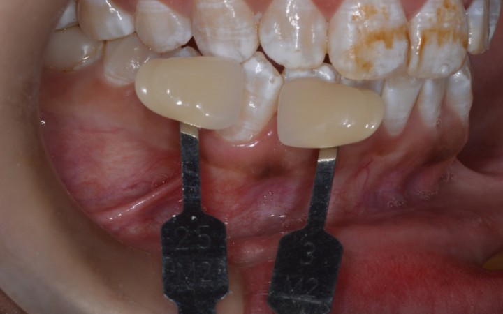 Tomou-se como referência as áreas dentárias com menor manchamento, encontrando a cor 3M2 nos caninos e pré molares superiores na escala VITA Bleachedguide 3D-MASTER