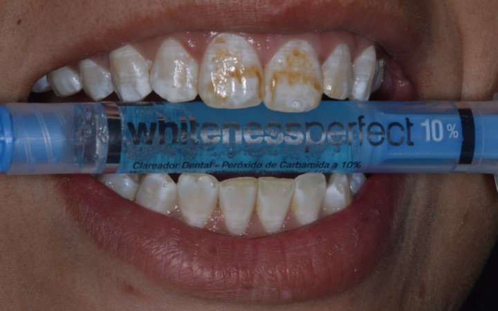Foi utilizada uma seringa de Whiteness Perfect 10% com a intenção de diminuir o contraste entre a cor do substrato dentário e das manchas brancas