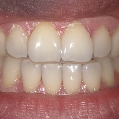 Clareamento dental sem relato de sensibilidade