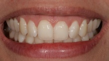 Situação inicial do caso demonstrando a movimentação do dente 21 para palatino