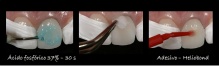 Tratamento da superfície dentária com ácido fosfórico a 37% durante 30s e utilização do sistema adesivo Heliobond.