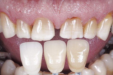  Tomada de cor prévia ao clareamento dental com as cores A1, A3 e A4