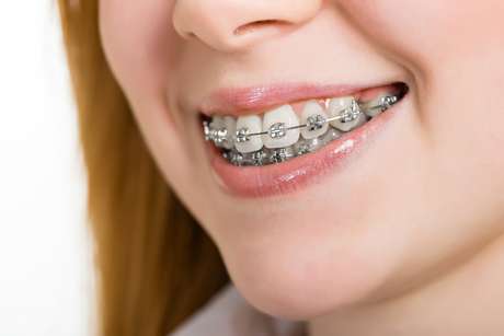 Aparelho ortodôntico pode deixar os dentes moles