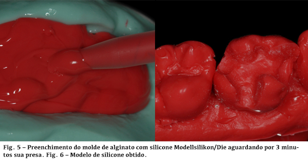 Preenchimento do molde de alginato com silicone Modellsilikon e Modelo de silicone obtido