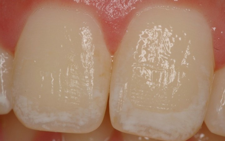 Análise inicial - Microabrasão Associada ao Clareamento Dental