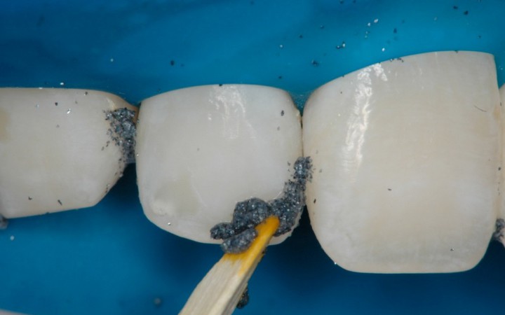 Clareamento - Microabrasão Associada ao Clareamento Dental