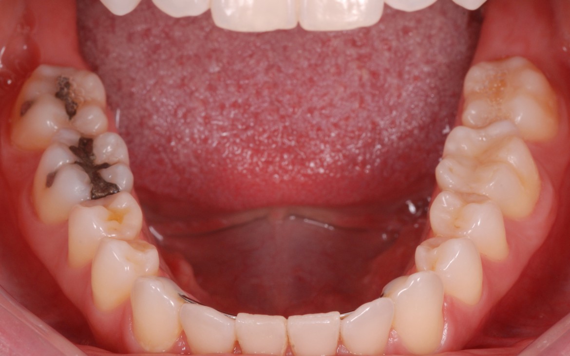 figura 2 - Arcada inferior seca e lábios afastados