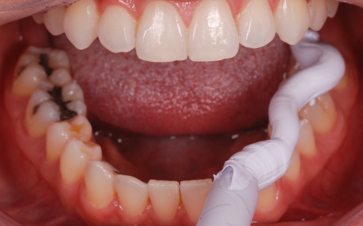 figura 4 -Variotime Bite sendo dispensado sobre a face oclusal e incisal dos dentes inferiores