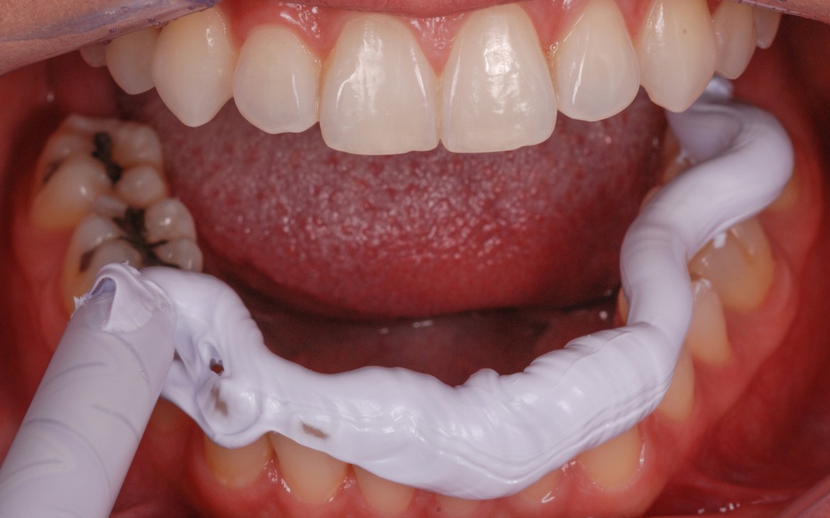 figura 5 - Variotime Bite sendo dispensado sobre a face oclusal e incisal dos dentes inferiores