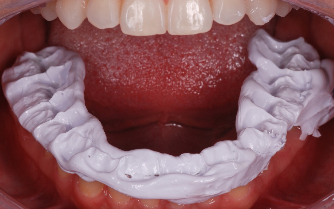 figura 7 - paciente de boca aberta após a presa do material