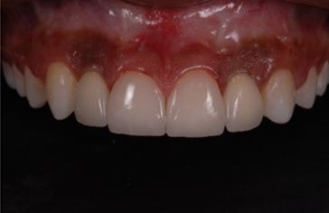 Microlaminados-reabilitacao-estetica-11 Microlaminados-reabilitacao-estetica-11