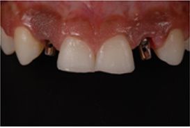 Microlaminados-reabilitacao-estetica-13 Microlaminados-reabilitacao-estetica-13