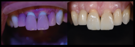 fluorescência nas cerâmicas dentais 7