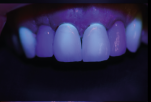 fluorescência nas cerâmicas dentais 9