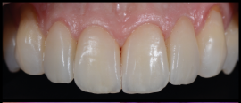 fluorescência nas cerâmicas dentais 5