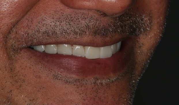 Caso-clinico-kulzer-12 caso clínico kulzer