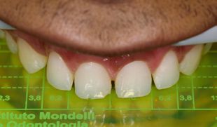 adesivo-gluma-bond-kulzer-6 adesivo-gluma-bond-kulzer-6