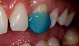 adesivo-gluma-bond-kulzer-10 adesivo-gluma-bond-kulzer-10