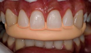 adesivo-gluma-bond-kulzer-12 adesivo-gluma-bond-kulzer-12