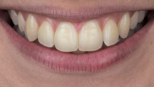 Clareamento dental caseiro Whiteness Perfect