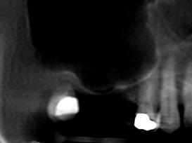 reabilitação de região posterior de maxila - figura 1 reabilitação de região posterior de maxila - figura 1