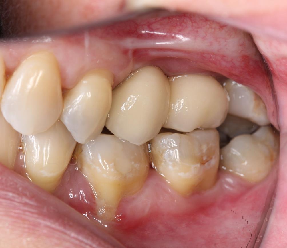 reabilitação de região posterior de maxila - figura 11 reabilitação de região posterior de maxila - figura 11