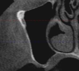 reabilitação de região posterior de maxila - figura 2