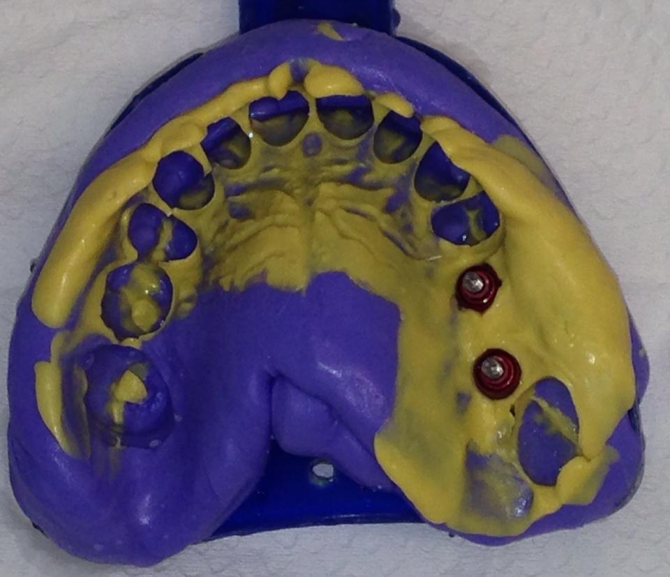 reabilitação de região posterior de maxila - figura 7