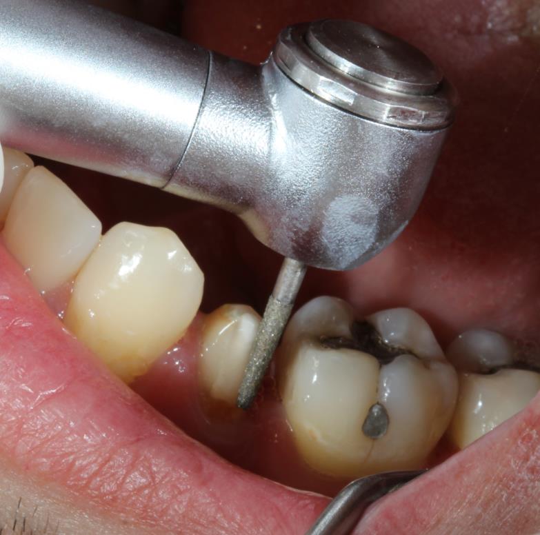 Caso clínico Nova DFL - figura 5 Caso clínico Nova DFL - figura 5