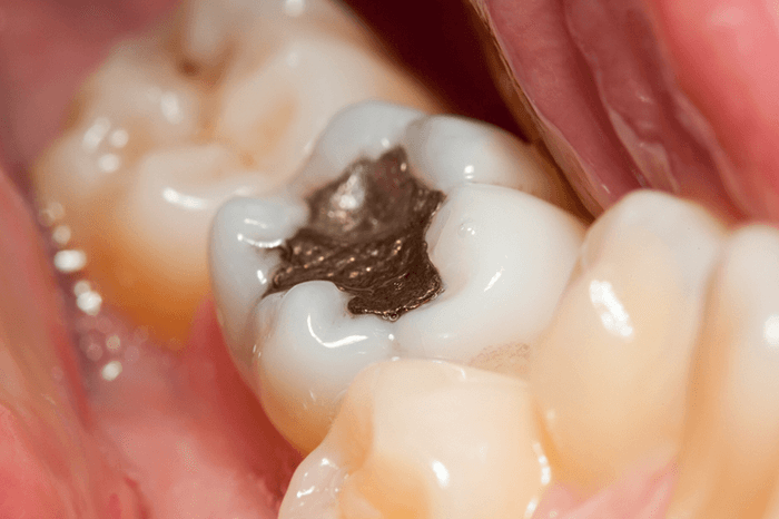 qual o melhor material para restauração dentária