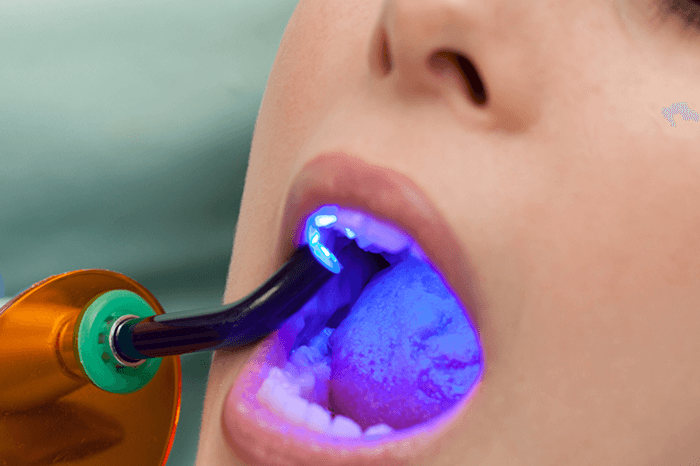 qual o melhor material para restauração dentária