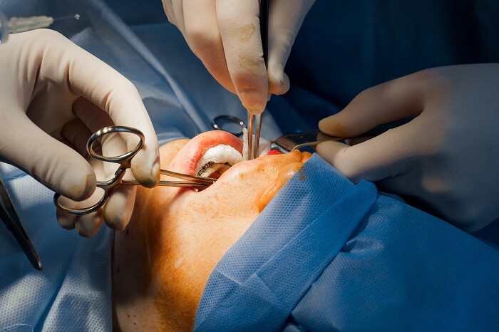 Cirurgia de bichectomia