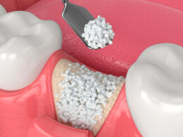 enxerto ósseo sintético usado em cirurgia e traumatologia bucomaxilofacial, implantodontia e periodontia