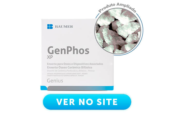 enxerto ósseo sintético GenPhos.