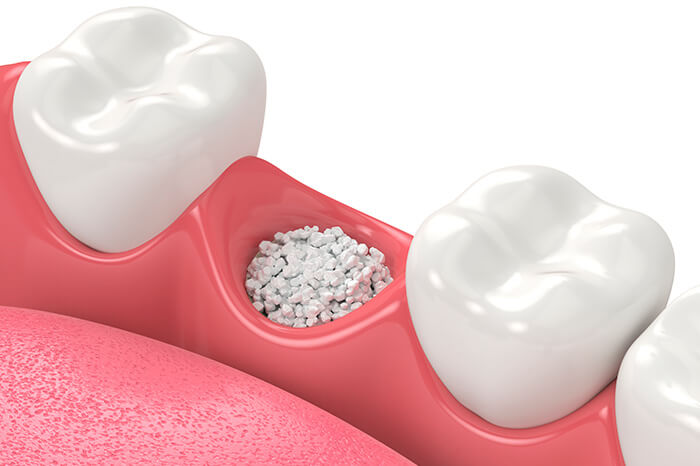 enxerto ósseo sintético aloplástico.