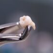 banco-de-dentes-humanos-dente-extraido