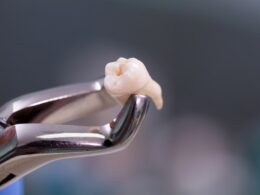 banco-de-dentes-humanos-dente-extraido