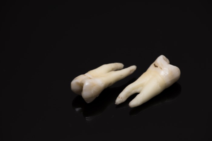 Dentes humanos extraídos.