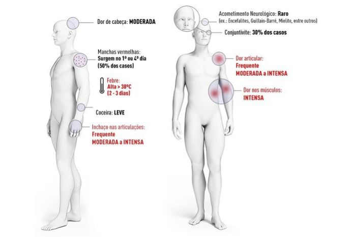 Ilustração com os sintomas da Chikungunya em cada parte do corpo.