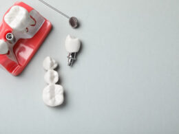 Modelo de implante dentário para consultório odontológico.