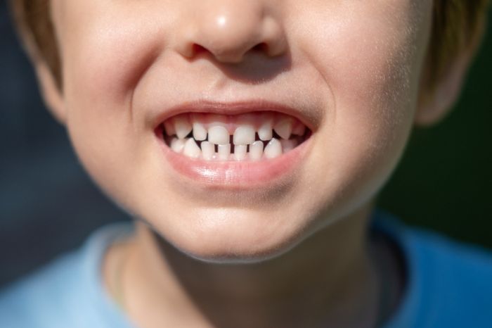 dentes decíduos