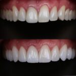 Dois sorrisos de antes e depois