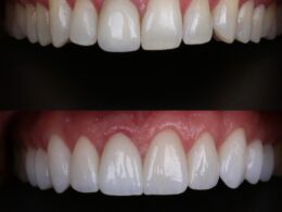 Dois sorrisos de antes e depois